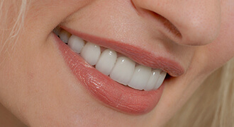 Smiling teeth with dental sealants