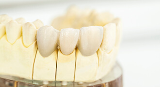 Dental implants displayed on a visual aid model