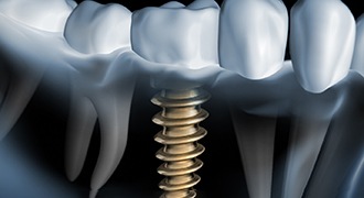 3D rendering of dental implant