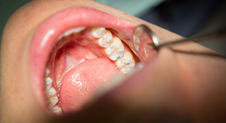 Tyler dental patient receiving tooth-colored filling