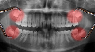 x-ray of impacted third molars