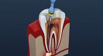 diagram of tooth being treated with root canal therapy 