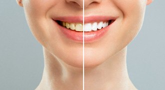 Patient's smile before and after teeth whitening