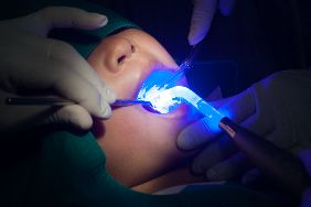 Child having sealants placed