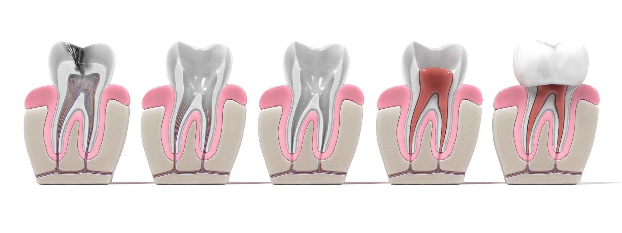3d renderings of endodontics root canal procedure Franklin Dental