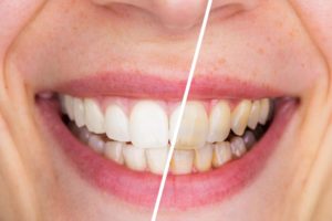 Teeth before and after whitening