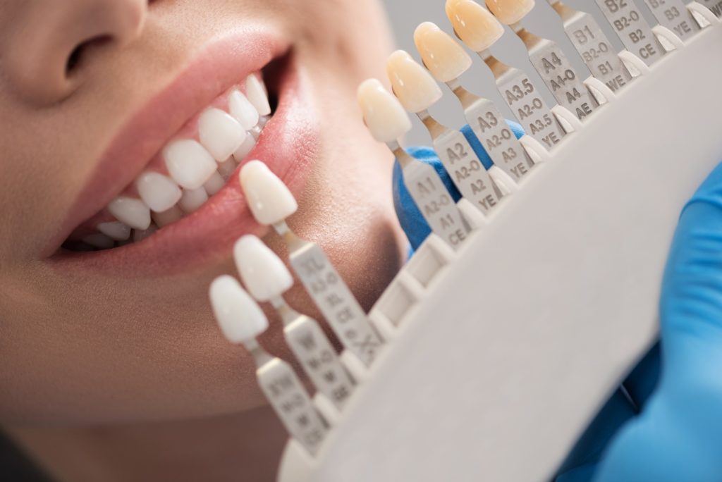 Patient smiling while dentist color-matches dental crown