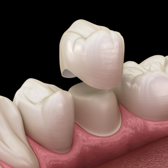 dental crowns